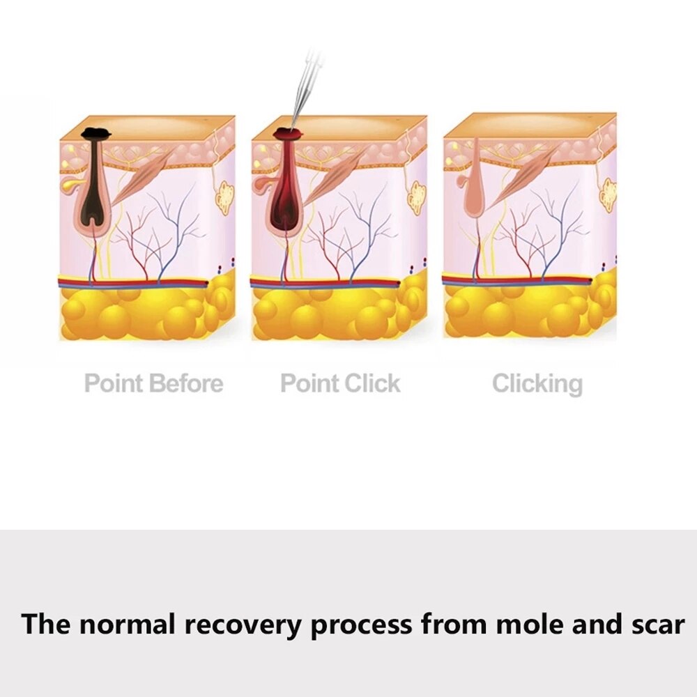 Mole removal instrument home